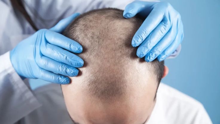 Best hair transplant in chennai