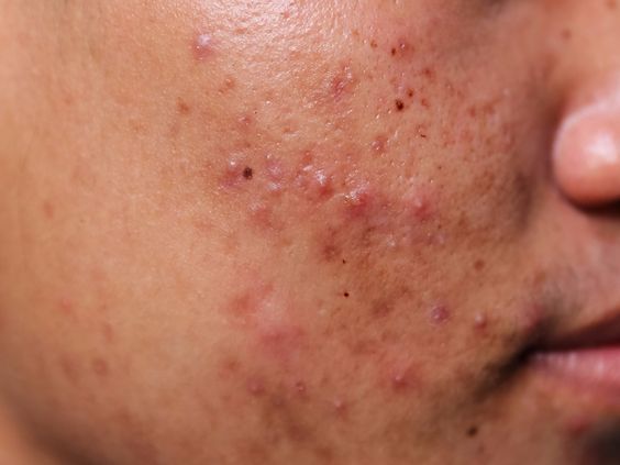 Best Acne Treatment in Chennai