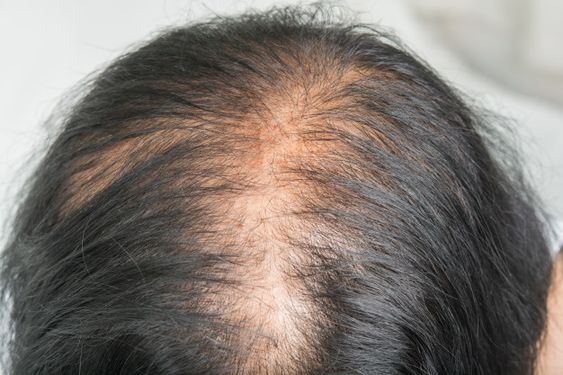 Female baldness treatment in Chennai