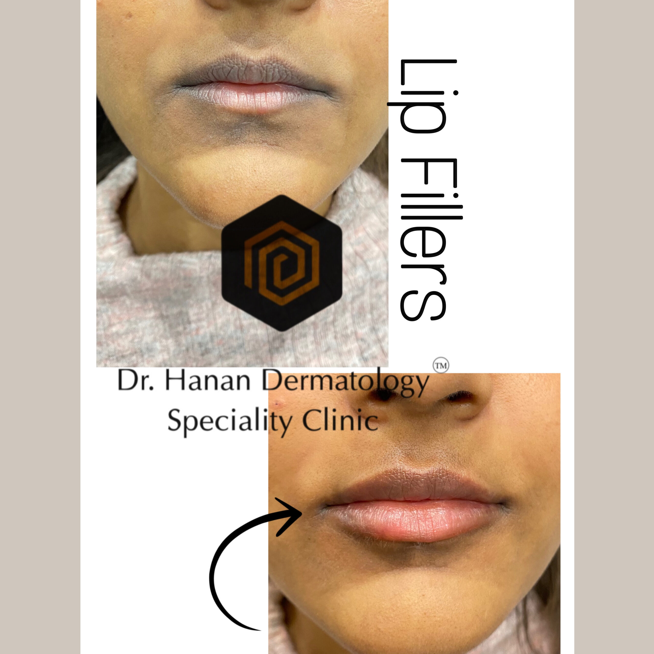 Best lip fillers treatment in chennai