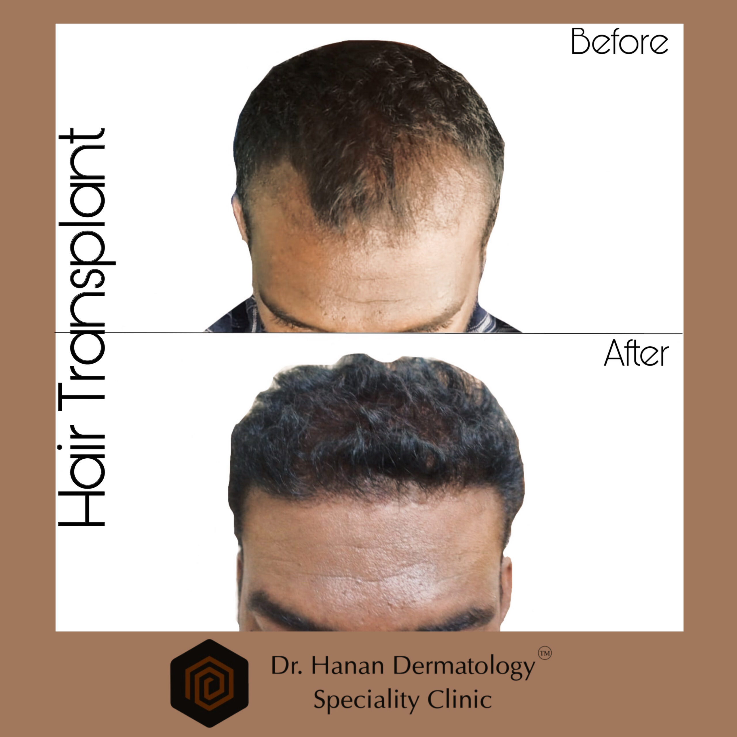 Hair transplant clinic in chennai