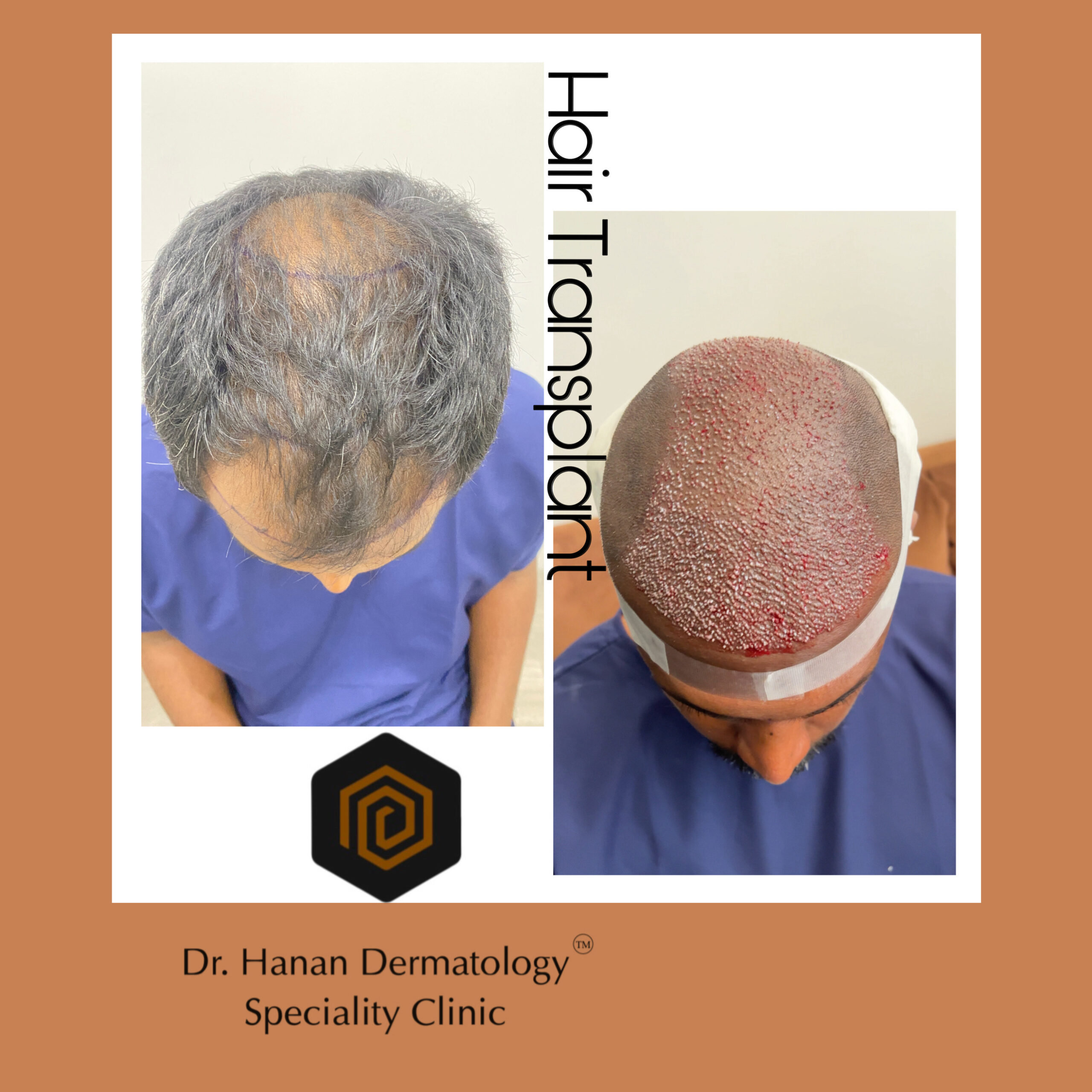 Best hair transplantation in Chennai