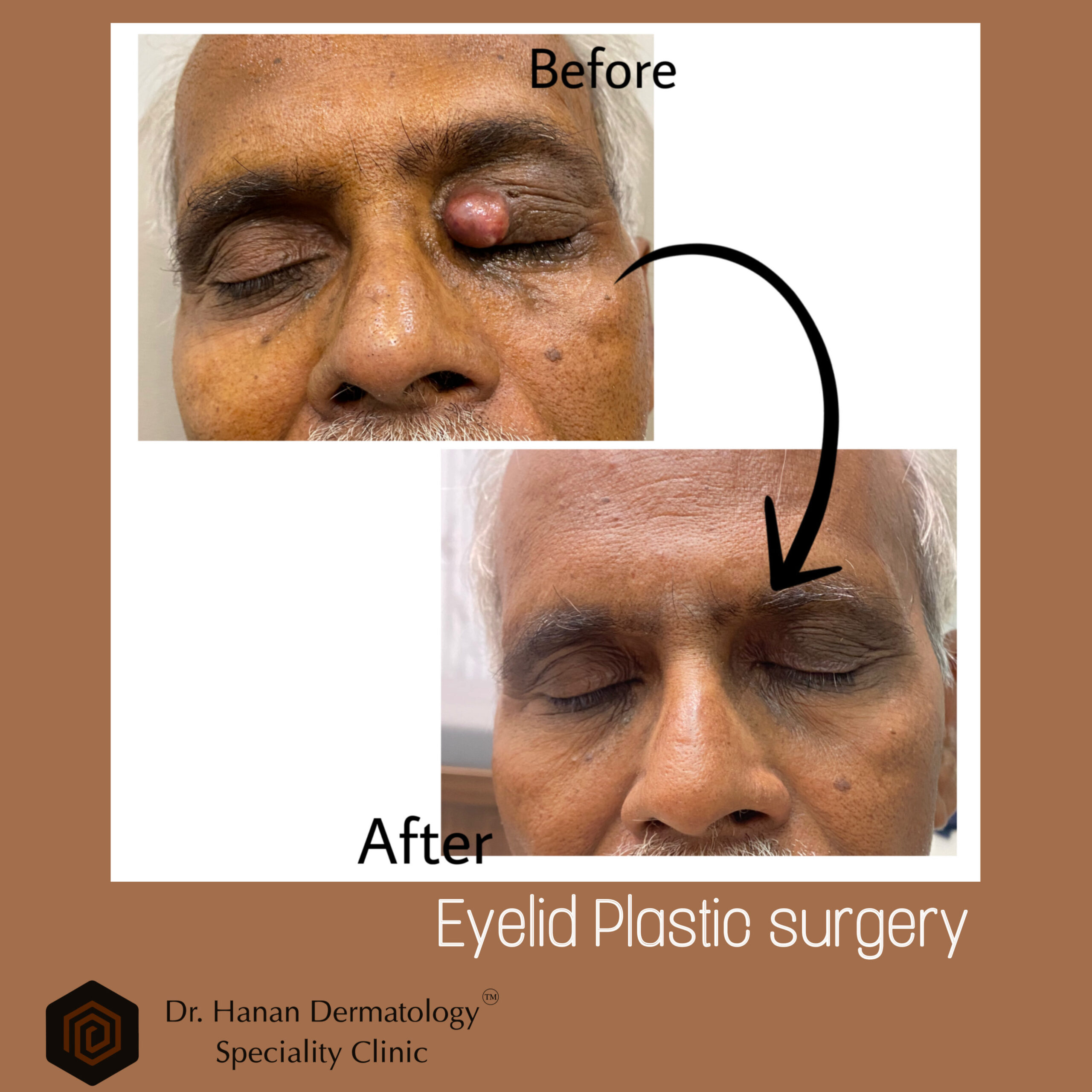 Eyelid plasilo surgery in chennai