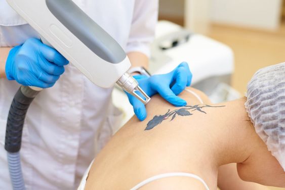 Laser Tattoo Removal Treatment In Chennai