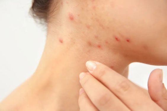 Scabies Treatment