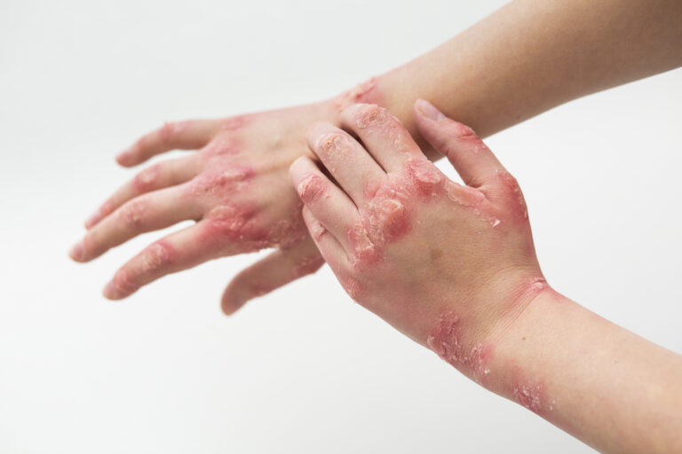 Best Psoriasis Treatment in Chennai