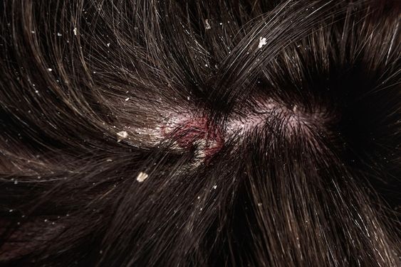 Best Dandruff Treatment in Chennai