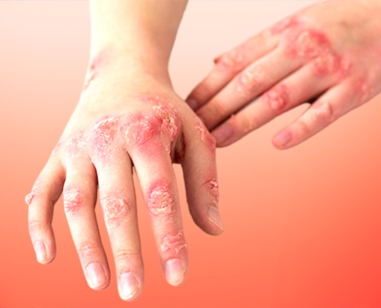 what is psoriasis