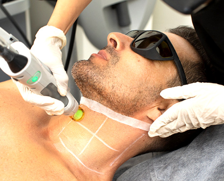 Laser Hair Removal