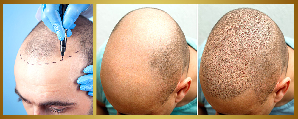 Hair Transplant