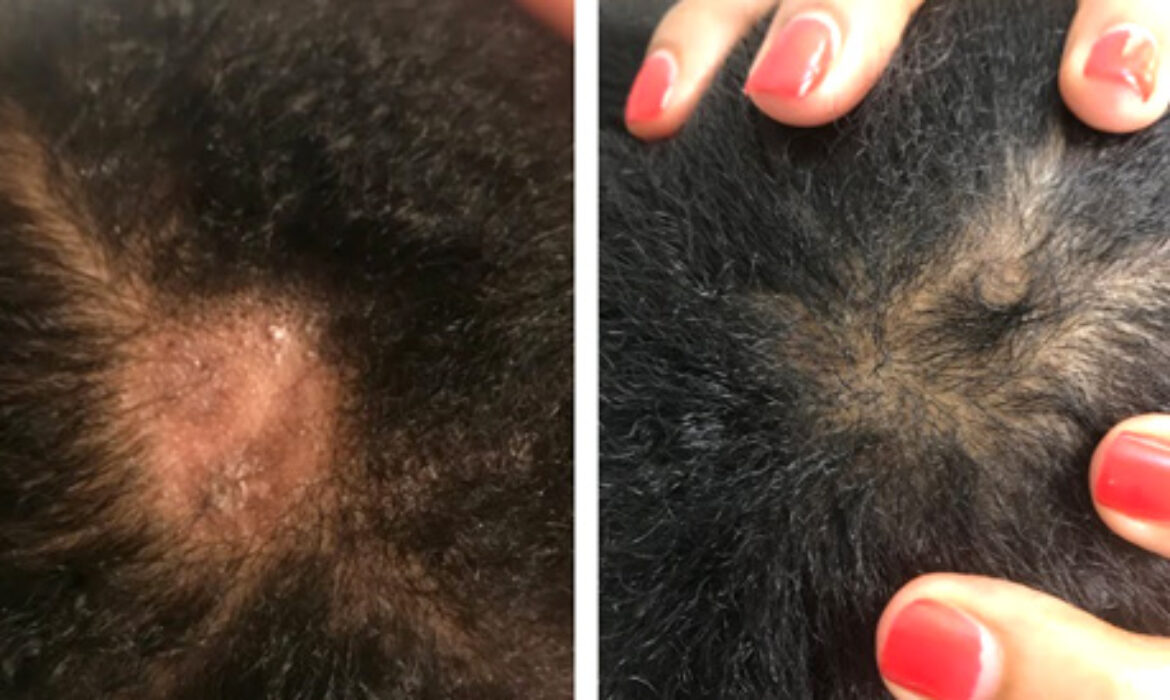 How to Regrow Hair on Bald Spots Fast