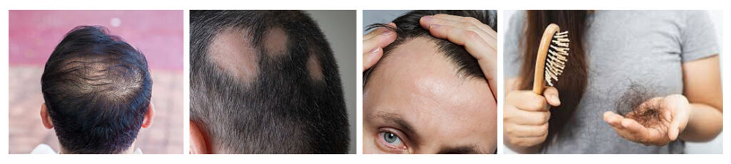 Hair Transplant Symptoms