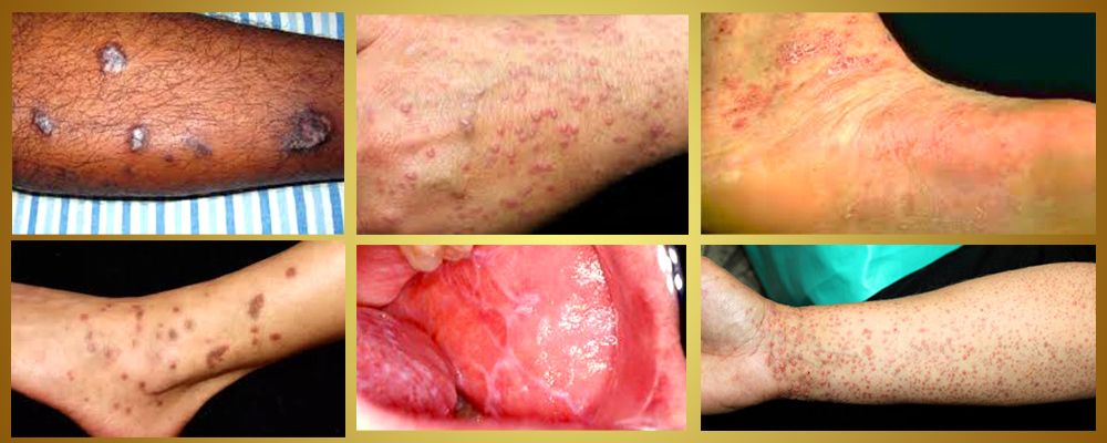 lichen planus