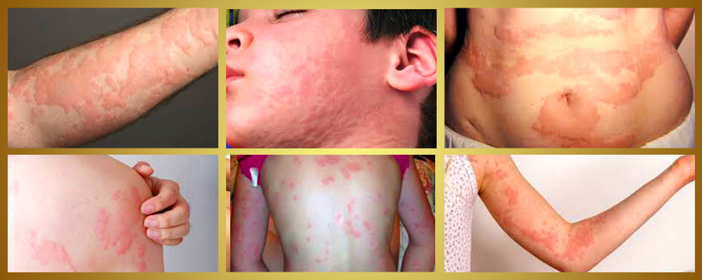 urticaria