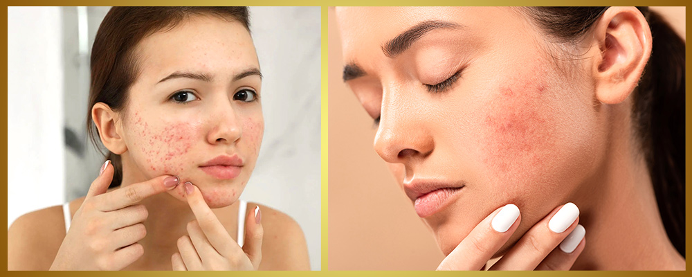 acne treatment in chennai