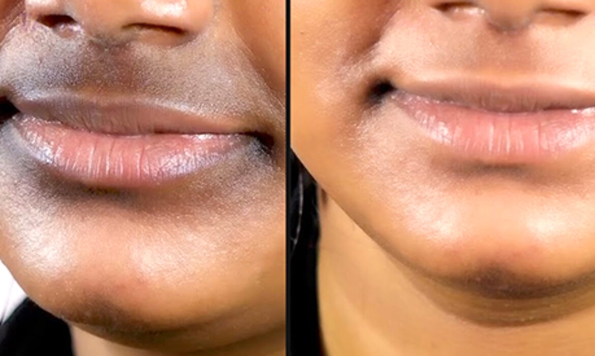 How to Reduce Pigmentation Around the Mouth