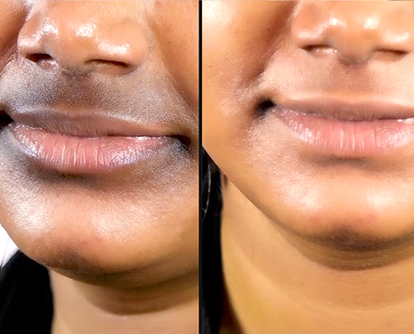 How to Reduce Pigmentation Around the Mouth