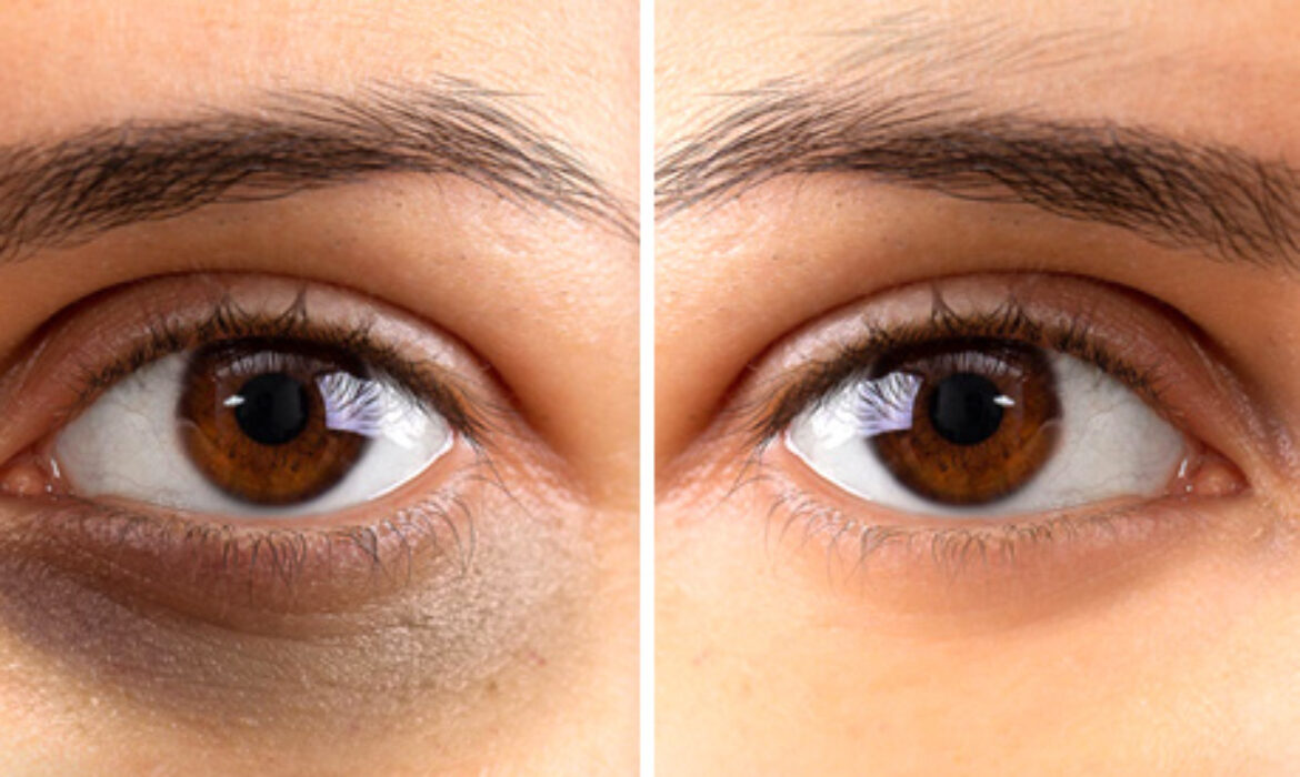 How to Remove Dark Circles Under Eyes