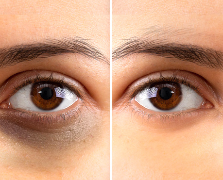 How to Remove Dark Circles Under Eyes