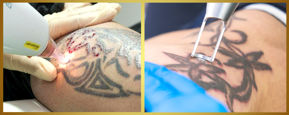 Laser tattoo removal