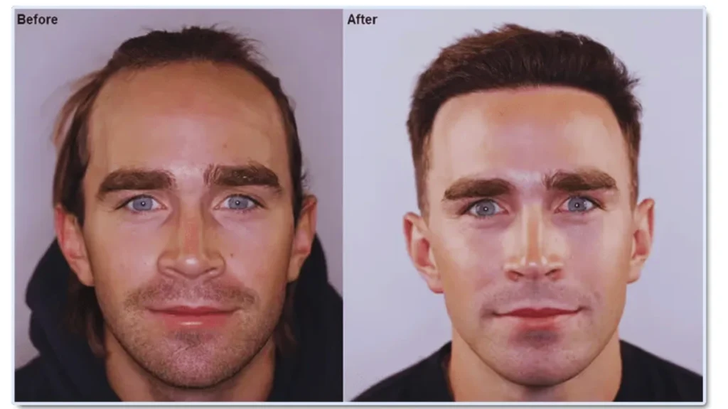 Best and Affordable Hair Transplant in Chennai: Top Solutions for Hair Restoration