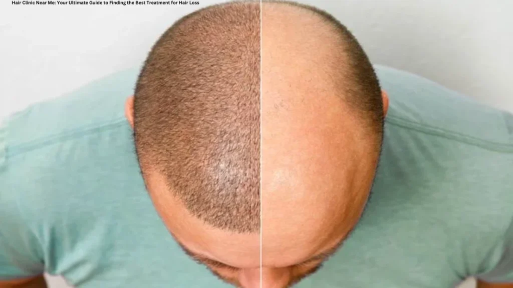 Hair Clinic Near Me: Your Ultimate Guide to Finding the Best Treatment for Hair Loss