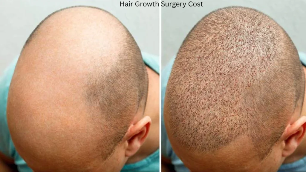 Hair Growth Surgery Cost