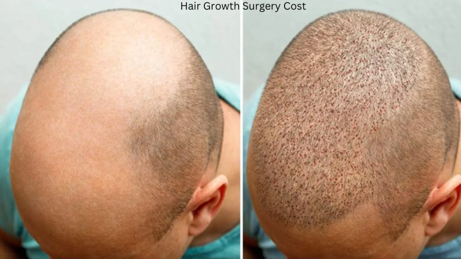 Hair Growth Surgery Cost