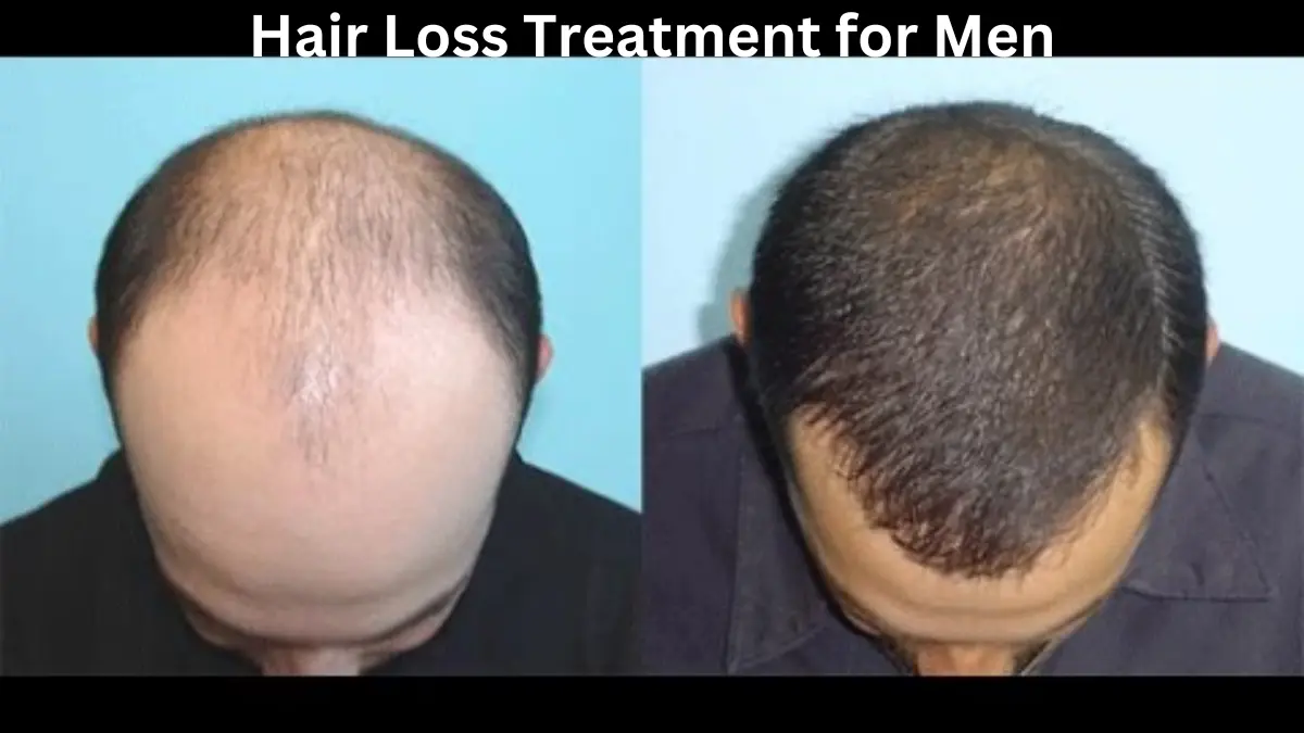 Hair Loss Treatment for Men Effective Solutions for Hair Regrowth