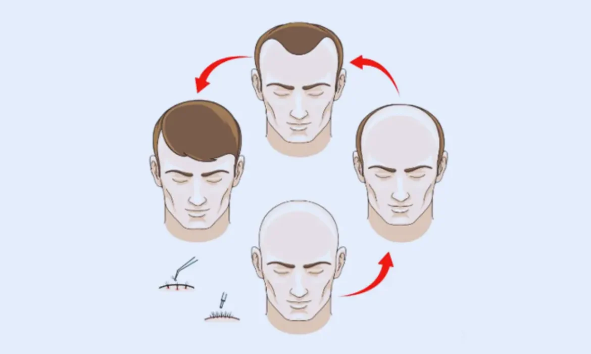 Hair Transplant Surgery in Chennai Your Ultimate Guide for 2025