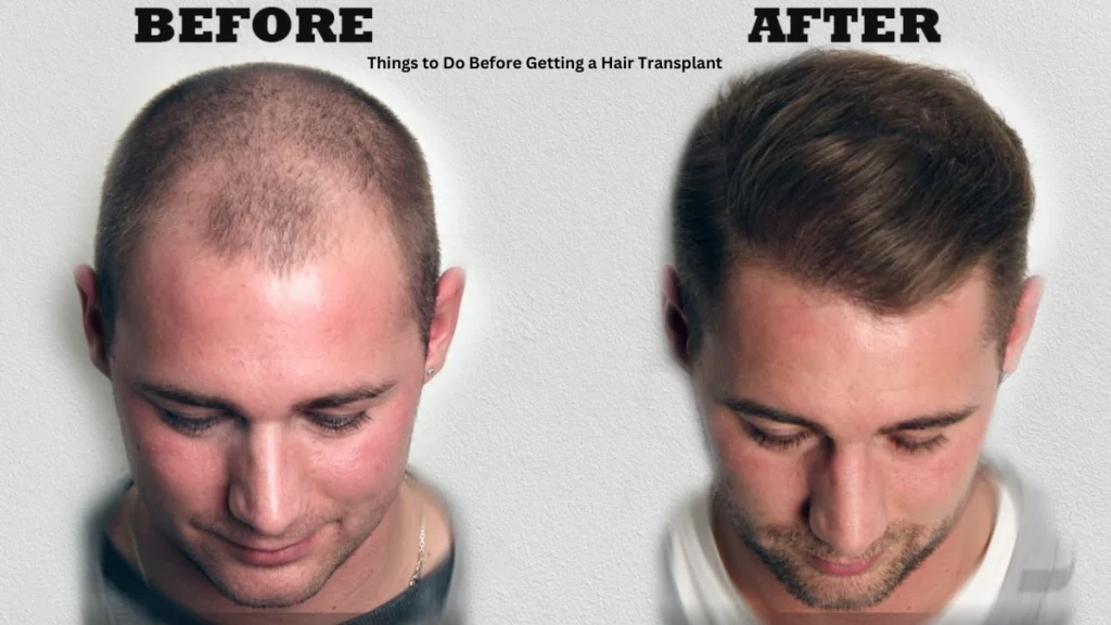 Things to Do Before Getting a Hair Transplant