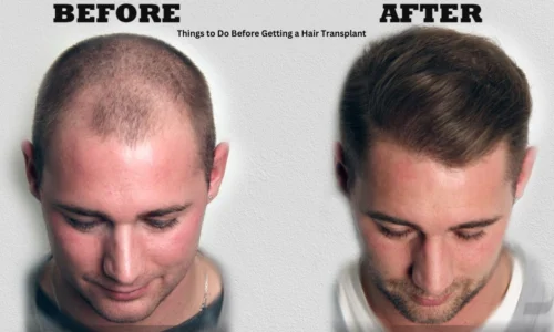 Things to Do Before Getting a Hair Transplant: A Complete Guide for a Successful Procedure