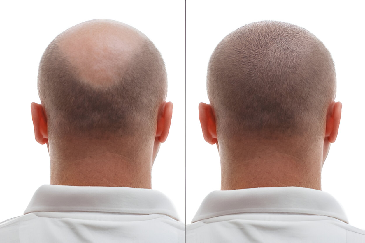 Benefits of hair trasnplant