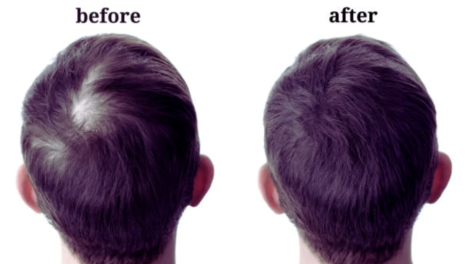 Hair Fall Treatment in India