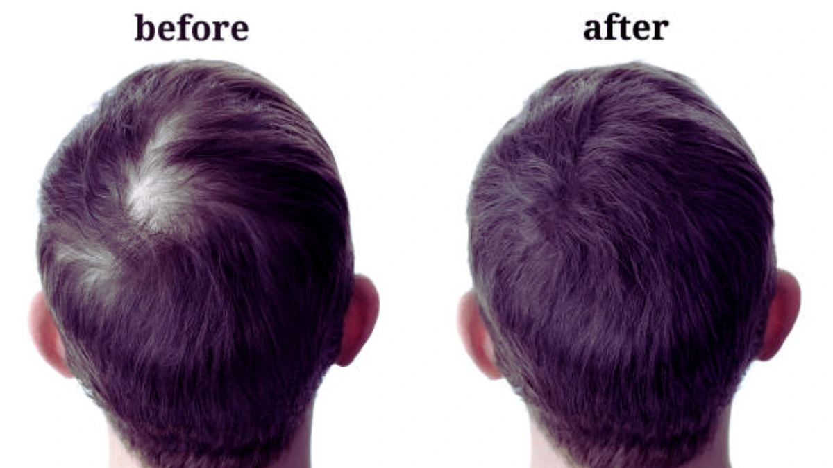 Hair Fall Treatment in India