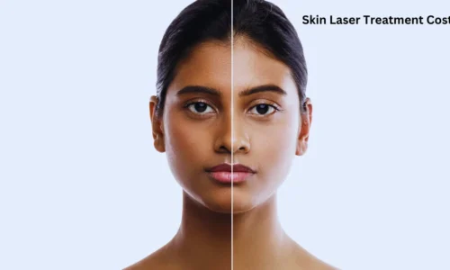 The Ultimate Guide to Skin Laser Treatment Costs
