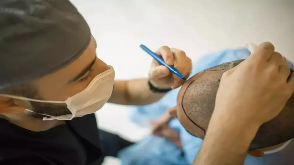 Best Hair Transplant in Tamil Nadu: Top Clinics, Cost & Techniques