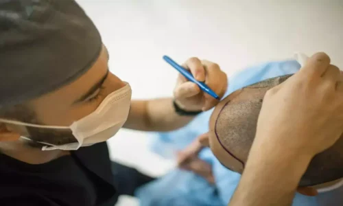 Best Hair Transplant in Tamil Nadu: Top Clinics, Cost & Techniques