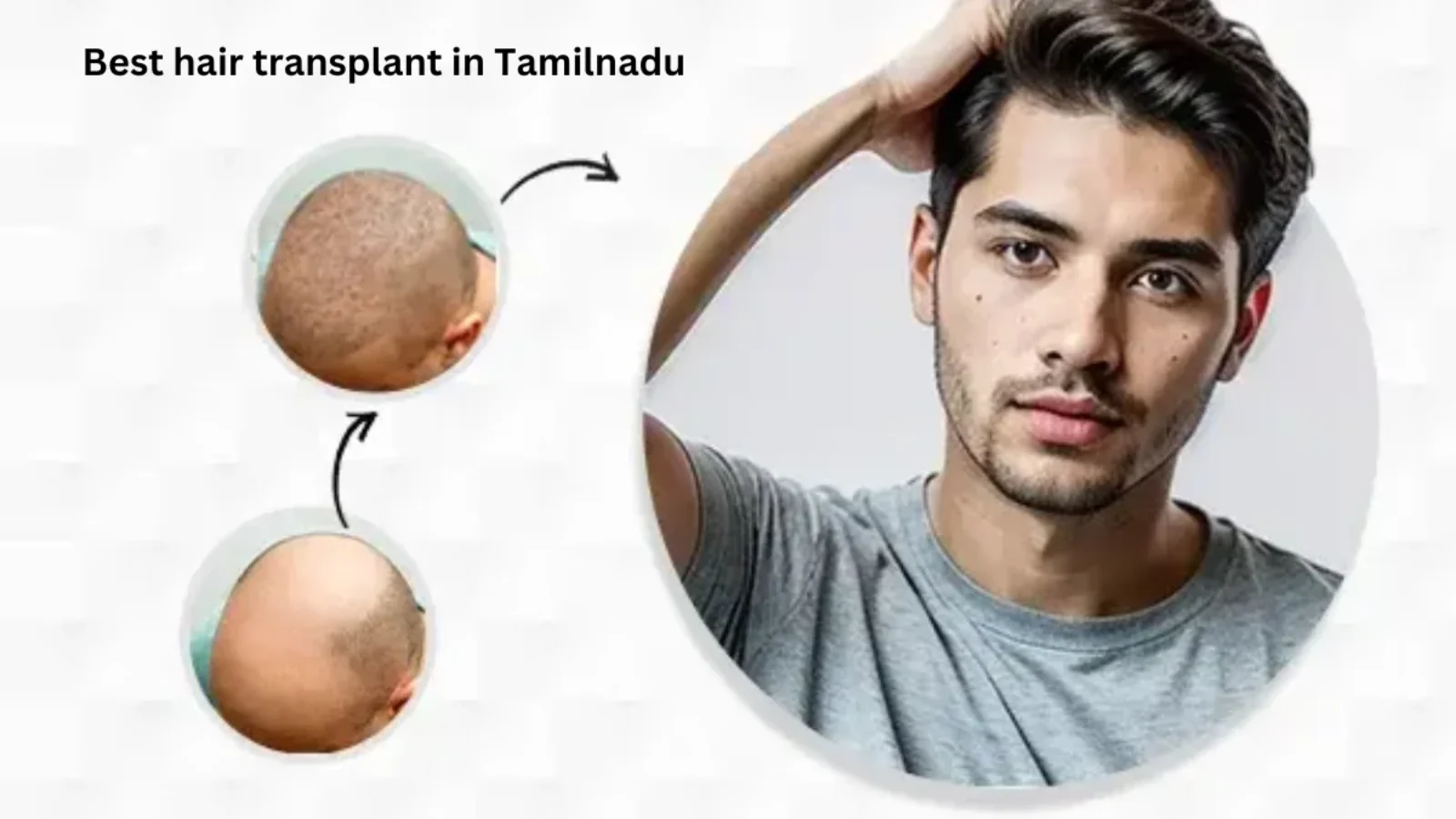 Best hair transplant in Tamilnadu