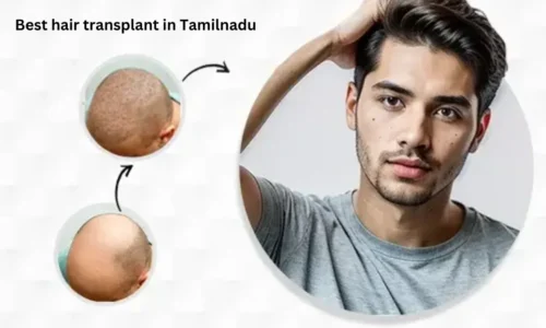 Best Hair Transplant in Tamil Nadu: Top Clinics, Cost & Techniques