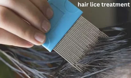 Hair Lice Treatment: Effective Remedies & Prevention Tips