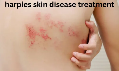 Comprehensive Guide to Harpies Skin Disease Treatment