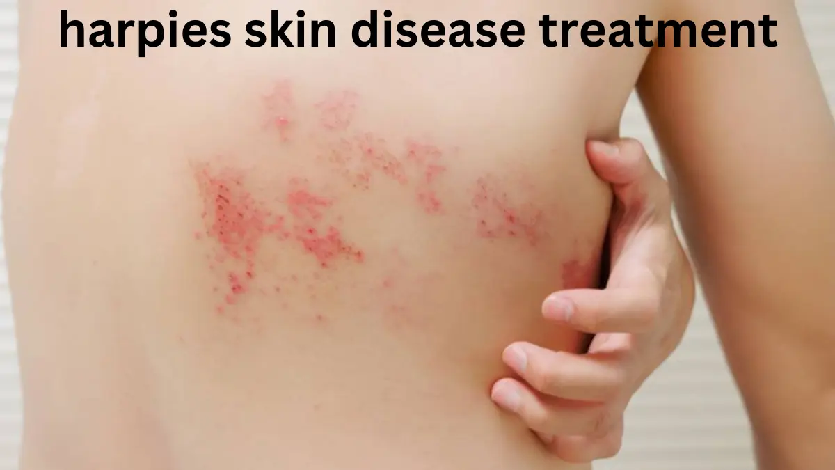 harpies skin disease treatment