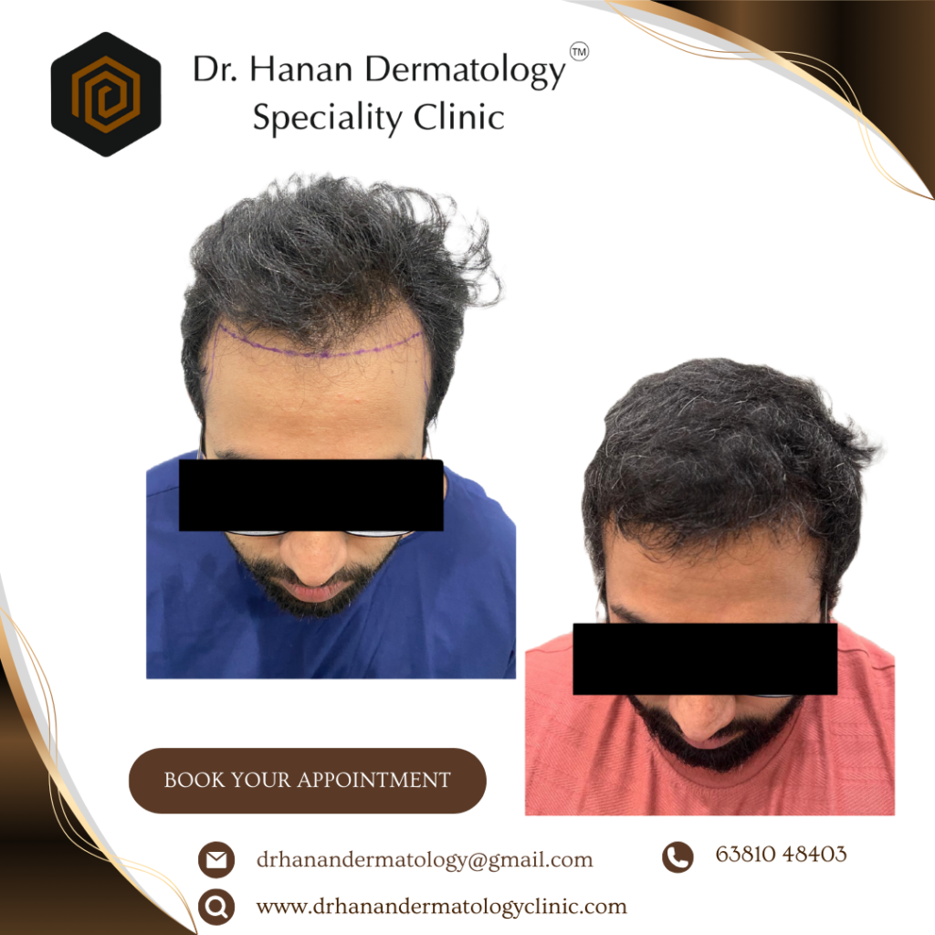 HT 1 (1) BEst hair transplant in chennai
