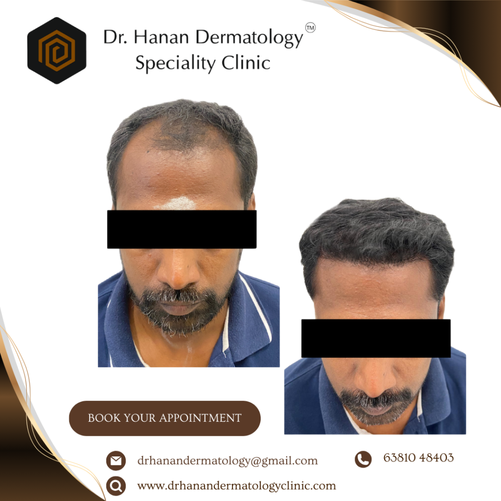 HT 2 Hair Trasnplant clinic in chennai