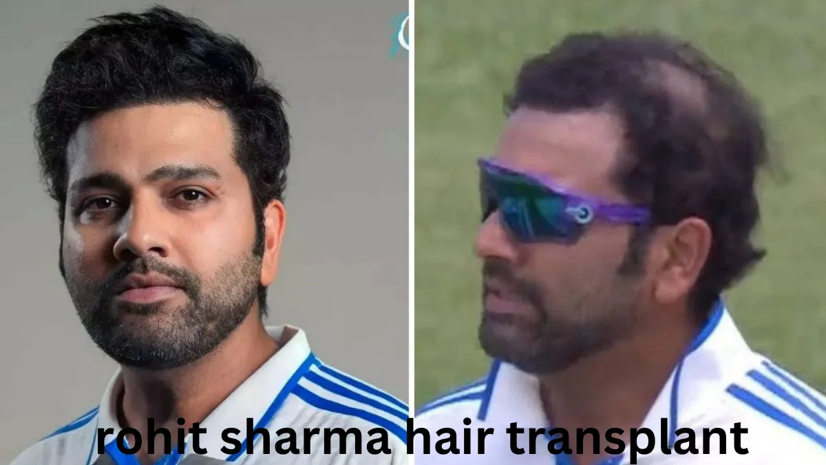 rohit sharma hair transplant