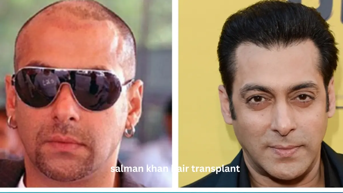 salman khan hair transplant