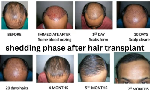 Shedding Phase After Hair Transplant: What to Expect & How to Care for Your Scalp