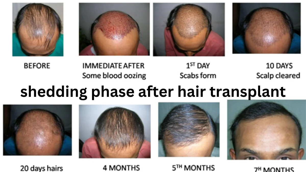 shedding phase after hair transplant