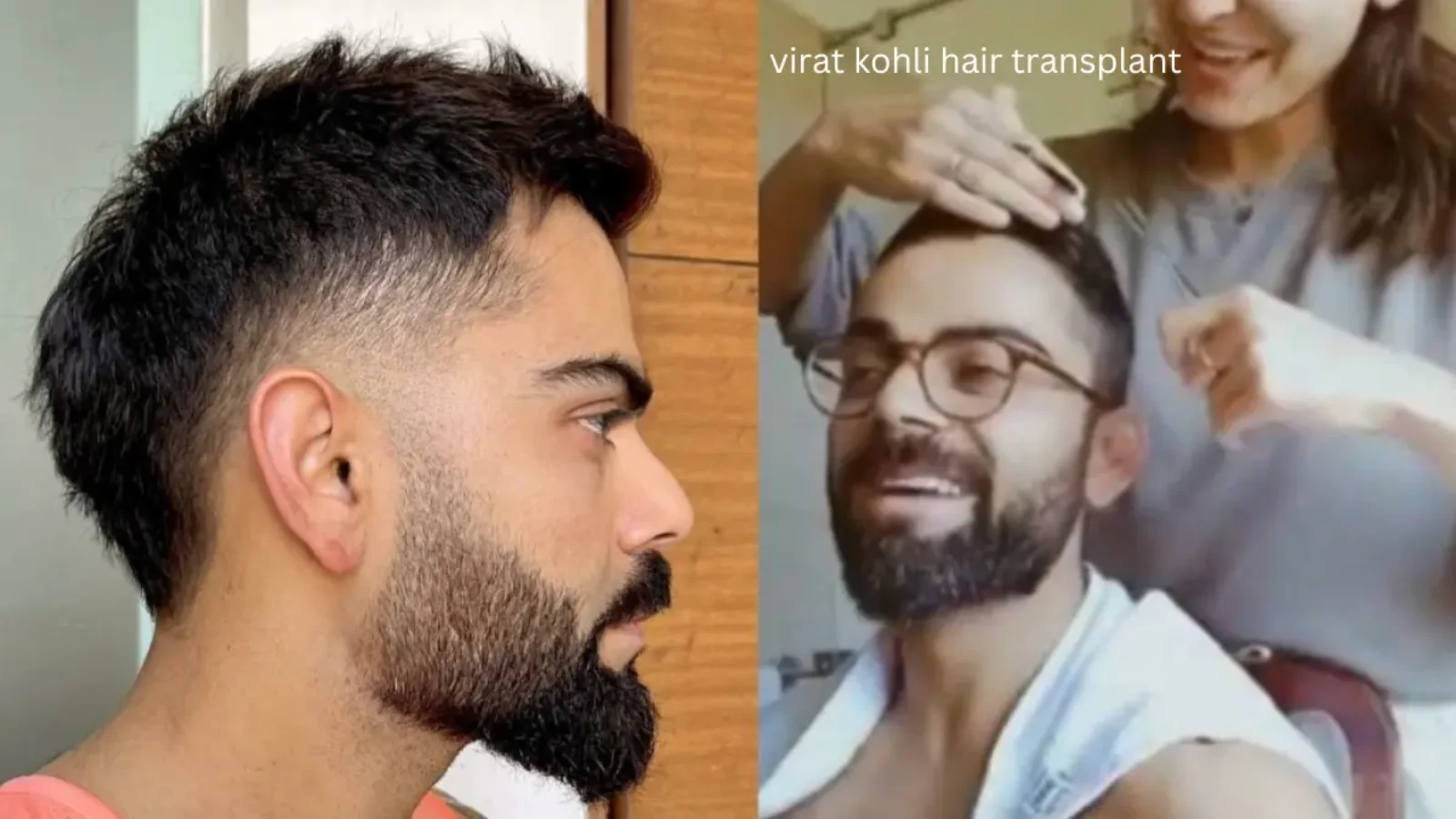 virat kohli hair transplant